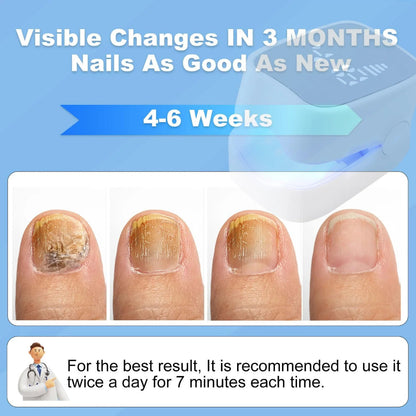 Nail Fungus Cleaning Laser Device